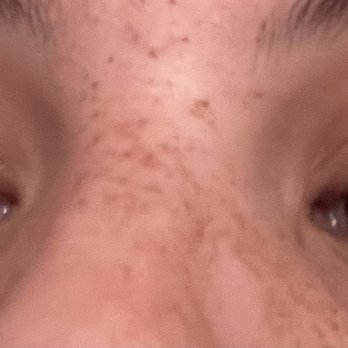 AK Nails & Spa - Redness and burns on eyelids (centers) - Nail Salons Near Me - Concord, California AK Nails & Spa - Redness and burns on eyelids (centers) - Nail Salons Near Me - Concord, California