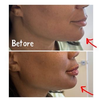 Diamond Med Spa - Chin fillers - Medical Spas Near Me - Miami Beach, Florida Diamond Med Spa - Chin fillers - Medical Spas Near Me - Miami Beach, Florida