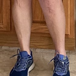 Rothman Orthopaedics - Misaligned knee after TKA.