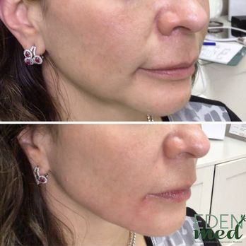 Eden Med - 2 syringes of Versa filler - Medical Spas Near Me - Boca Raton, Florida Eden Med - 2 syringes of Versa filler - Medical Spas Near Me - Boca Raton, Florida