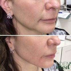 Eden Med - 2 syringes of Versa filler