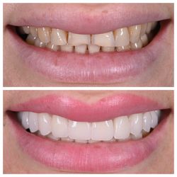 Signal Hill Dental Care - Porcelain Veneers makeover