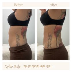 Bear Body Skin - Hifu Body Contour