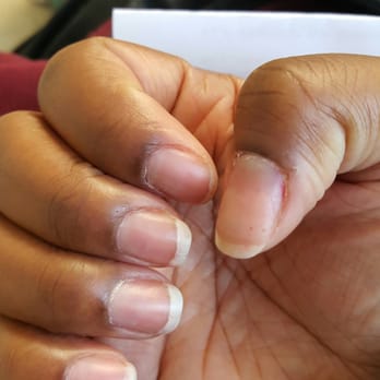 Classy Nails and Spa - After day 3 - Nail Salons Near Me - Orland Park, Illinois