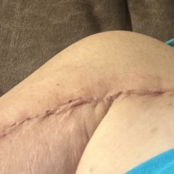 Orthopedic and Sports Institute of the Fox Valley - Shoulder Surgery