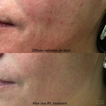 Vivaa - Brown spot treatment with IPL. - Vascular Medicine Near Me - Bellevue, Washington Vivaa - Brown spot treatment with IPL. - Vascular Medicine Near Me - Bellevue, Washington