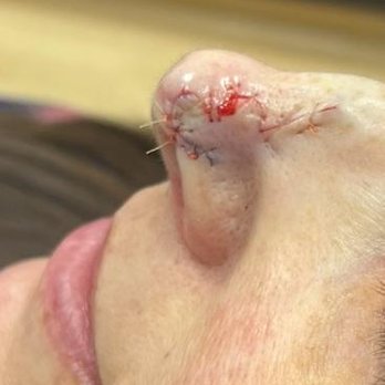 Ali Hendi, MD - Reconstruction with bi-lobed flap complete. - Dermatologists Near Me - Chevy Chase, Maryland