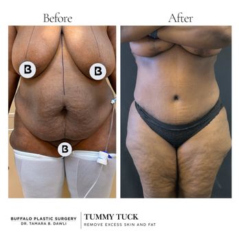Buffalo Plastic Surgery - tummy tuck before and after - Medical Spas Near Me - Amherst, New York