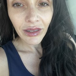 Chic la Vie Med Spa - My temple and lip filler immediately after!