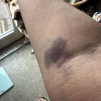 Quest Diagnostics - Blood draw the day after :( - Laboratory Testing Near Me - Clearwater, Florida Quest Diagnostics - Blood draw the day after :( - Laboratory Testing Near Me - Clearwater, Florida