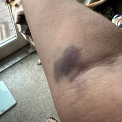 Quest Diagnostics - Blood draw the day after :(