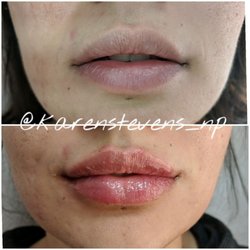A Perfect You - Lip filler before and after