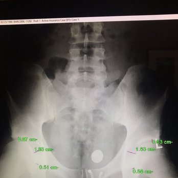 Aurora Chiropractic - I was skeptical of the x rays, but you can clearly see the misalignments and measurements. - Chiropractors Near Me - Aurora, Illinois Aurora Chiropractic - I was skeptical of the x rays, but you can clearly see the misalignments and measurements. - Chiropractors Near Me - Aurora, Illinois