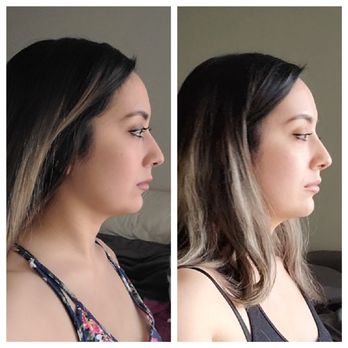 AnwarMD.com - Fillers (before left, after right). So happy! - Medical Spas Near Me - Roseville, California