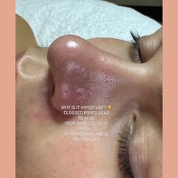 Divinity Spa - AFTER
Clean skin
Unclogged pores
Smoother & glowing
Visible results after just one session