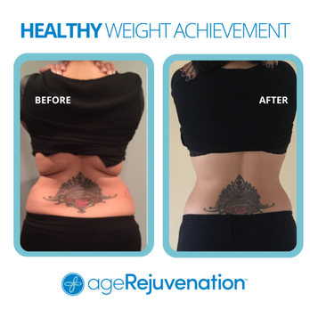 AgeRejuvenation - Brandon - Real Patient RESULTS at ageRejuvenation - Weight Loss Centers Near Me - Brandon, Florida