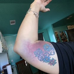 KEDPLASMA San Antonio - The arm they re stuck .... Painful