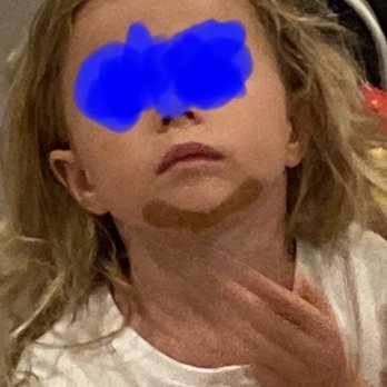 Vik Complete Care Lakeway - Professional job of 4 stitches executed without 3yr old child crying. - Urgent Care Near Me - Lakeway, Texas Vik Complete Care Lakeway - Professional job of 4 stitches executed without 3yr old child crying. - Urgent Care Near Me - Lakeway, Texas