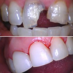 Badly damage tooth
Look at this masterpiece . Fixed with composite Veneers to give this wonderful patient a bright and beautiful smile.