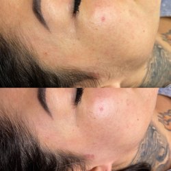T&G Esthetics - Before and After Dermaplane