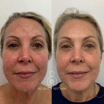 Beauty Within - Before and After 1 custom UltraClear treatment - Medical Spas Near Me - Boynton Beach, Florida