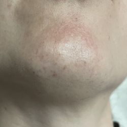 Ideal Electrolysis - After most recent session.