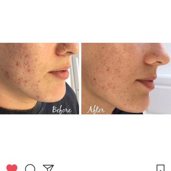 Invitation to Browse - After one chemical peel ! The results are amazing! I peeled for a couple days but everyone's different ! - Skin Care Near Me - Huntington Beach, California Invitation to Browse - After one chemical peel ! The results are amazing! I peeled for a couple days but everyone's different ! - Skin Care Near Me - Huntington Beach, California