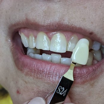 Smiles for You - Mobile Whitening Kit. Before - Teeth Whitening Near Me Smiles for You - Mobile Whitening Kit. Before - Teeth Whitening Near Me