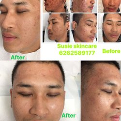 Susie Skin Care Clinic - Stop your acne and scar.