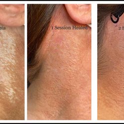 BEAUTYINK - Our client has Lichen Sclerosis and with 2 sessions we were able to camouflage her scarring.