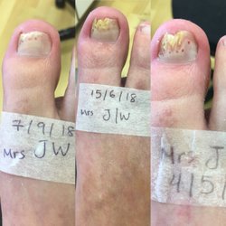 Healthy Happy Feet - Lacuna Method fungal nail treatment