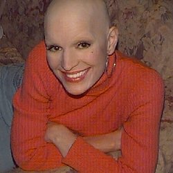 Alternative Hair - Alopecia Areata