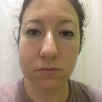 Patricia Claeys-Schmidt, DDS - My face for TWO WEEKS after getting a cavity filled. It looks terrible, but it felt worse than it looked! - General Dentistry Near Me - San Francisco, California Patricia Claeys-Schmidt, DDS - My face for TWO WEEKS after getting a cavity filled. It looks terrible, but it felt worse than it looked! - General Dentistry Near Me - San Francisco, California