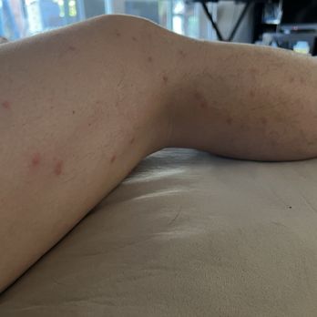 Makati Diamond Residences - More bed bug bites - Hotels Near Me - Makati, NCR