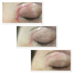 Beautiful You Skin and Body Rejuvenation - Process of reducing my scar. MICRO NEEDLING is a great way to get rid of indentation; STEM CELLS+LED light help creating new perfect cells