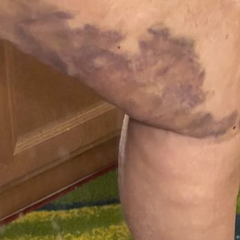 AirSculpt - Las Vegas - The after results are TOTALLY LUMPY AND WORSE THEN PRIOR TO PROCEDURE - Body Contouring Near Me - Henderson, Nevada AirSculpt - Las Vegas - The after results are TOTALLY LUMPY AND WORSE THEN PRIOR TO PROCEDURE - Body Contouring Near Me - Henderson, Nevada