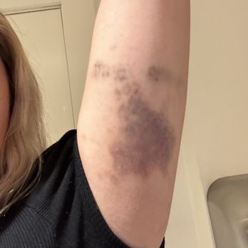Nebula - These were all the bruises caused by 3 security guards at nebula. - Dance Clubs Near Me - New York, New York Nebula - These were all the bruises caused by 3 security guards at nebula. - Dance Clubs Near Me - New York, New York