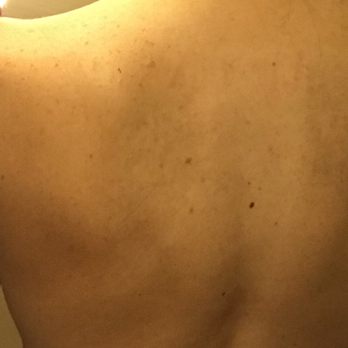Progress MD - Fully healed!!! - Medical Spas Near Me - Amarillo, Texas