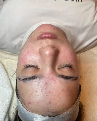 Acne Facial - Targeted deep-cleanse with extractions and LED therapy to reduce breakouts, inflammation, and congested skin. Acne Facial - Targeted deep-cleanse with extractions and LED therapy to reduce breakouts, inflammation, and congested skin.