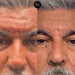 Makeup Mau Loa - Skin needling