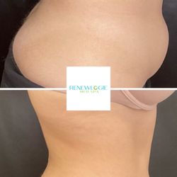 Renewlogie Med Spa - EmsculptNEO transformation at Renewlogie. Patient completed a series of 6.
