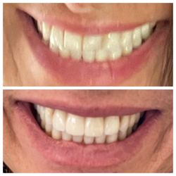 Nordahl Dental - Before and after Dr and entire staff are amazing!