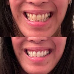 Best Teeth Whitening Las Vegas - Before and after level 11 to level 3