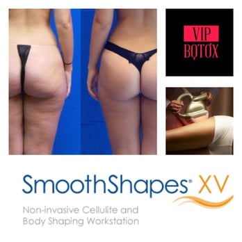 VIP Botox - Body shaping and contouring at its best! The latest technology in cellulite reduction. It works! - Medical Spas Near Me - San Juan, Puerto Rico