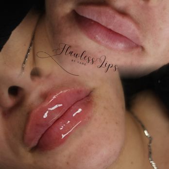 Flawless Lips - Needle free lip filler (Hyaluron Pen) - Teeth Whitening Near Me Flawless Lips - Needle free lip filler (Hyaluron Pen) - Teeth Whitening Near Me