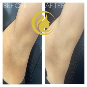 Aesthetica MedSpa - Initmate bleaching before and after - Medical Spas Near Me - Paramus, New Jersey Aesthetica MedSpa - Initmate bleaching before and after - Medical Spas Near Me - Paramus, New Jersey