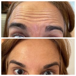 Melblu's Infusion And Wellness Studio - Botox before and after