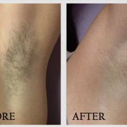 Hello Gorgeous Aesthetics - Underarm Wax