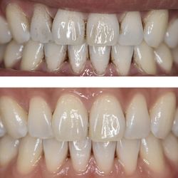 Smile Corners Dental - Before and after cleaning