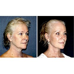 Ludwig A Allegra, MD - Endoscopic Browlift and Facelift